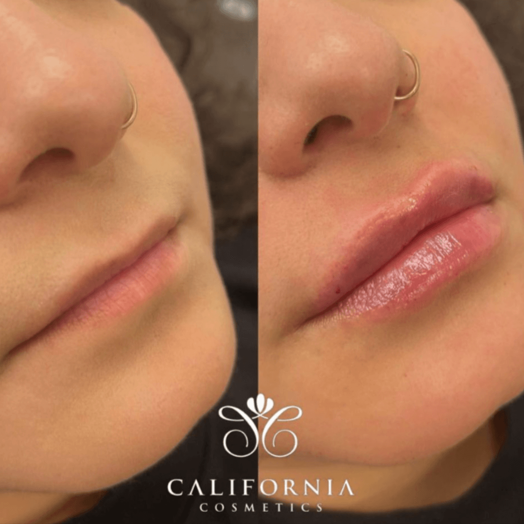lip-augmentation-rounded-and-full-lips