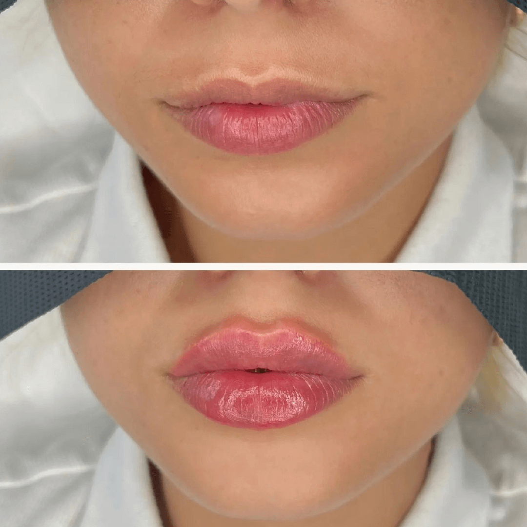 aumento-de-labios-tecnica-de-labio-ruso