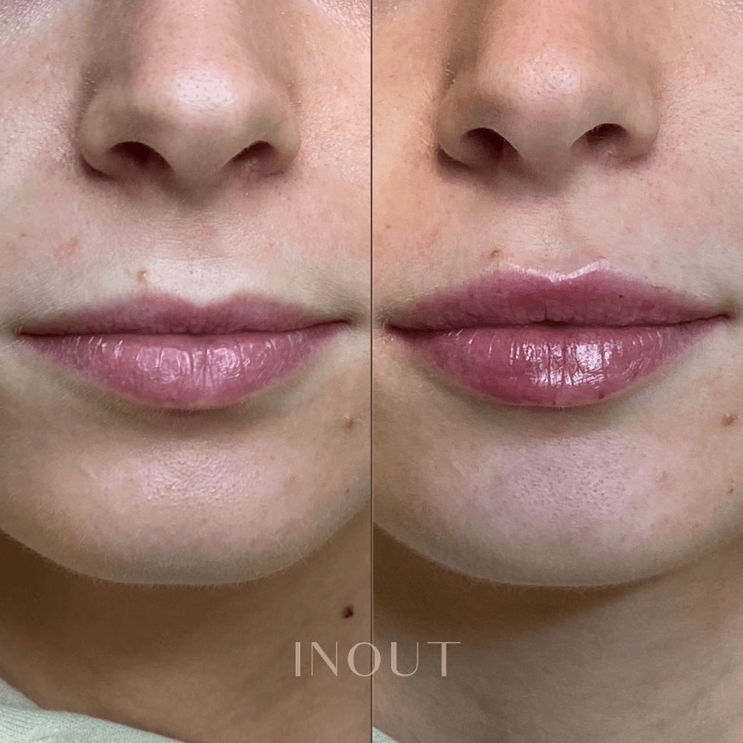 aumento-de-labios-labios-naturales