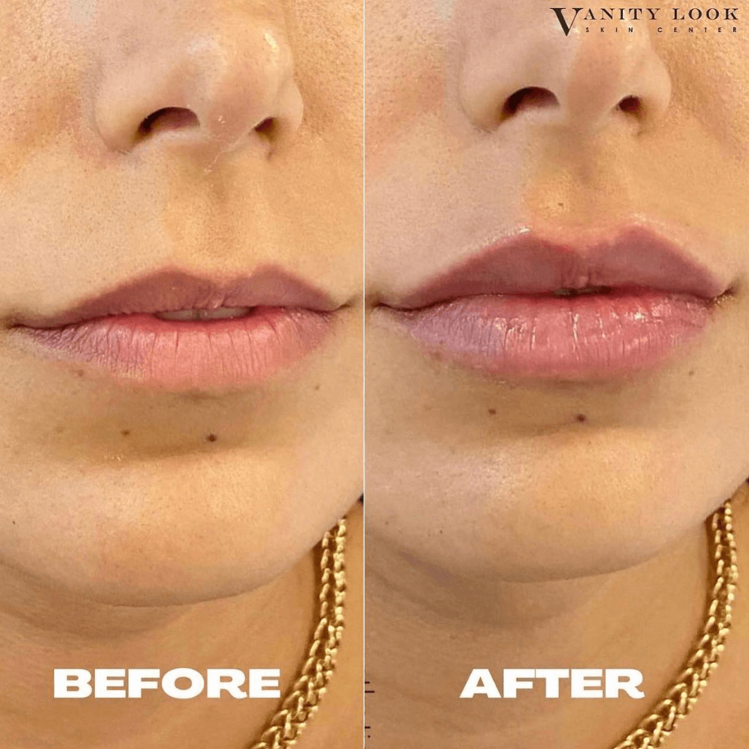 lip-augmentation-natural-lips