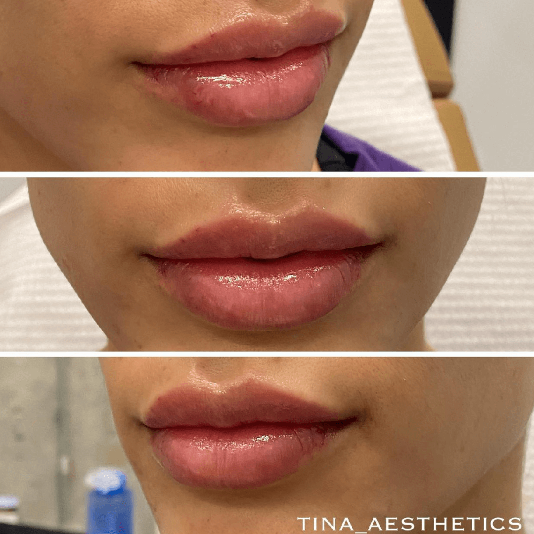 lip-augmentation-corner-lift 