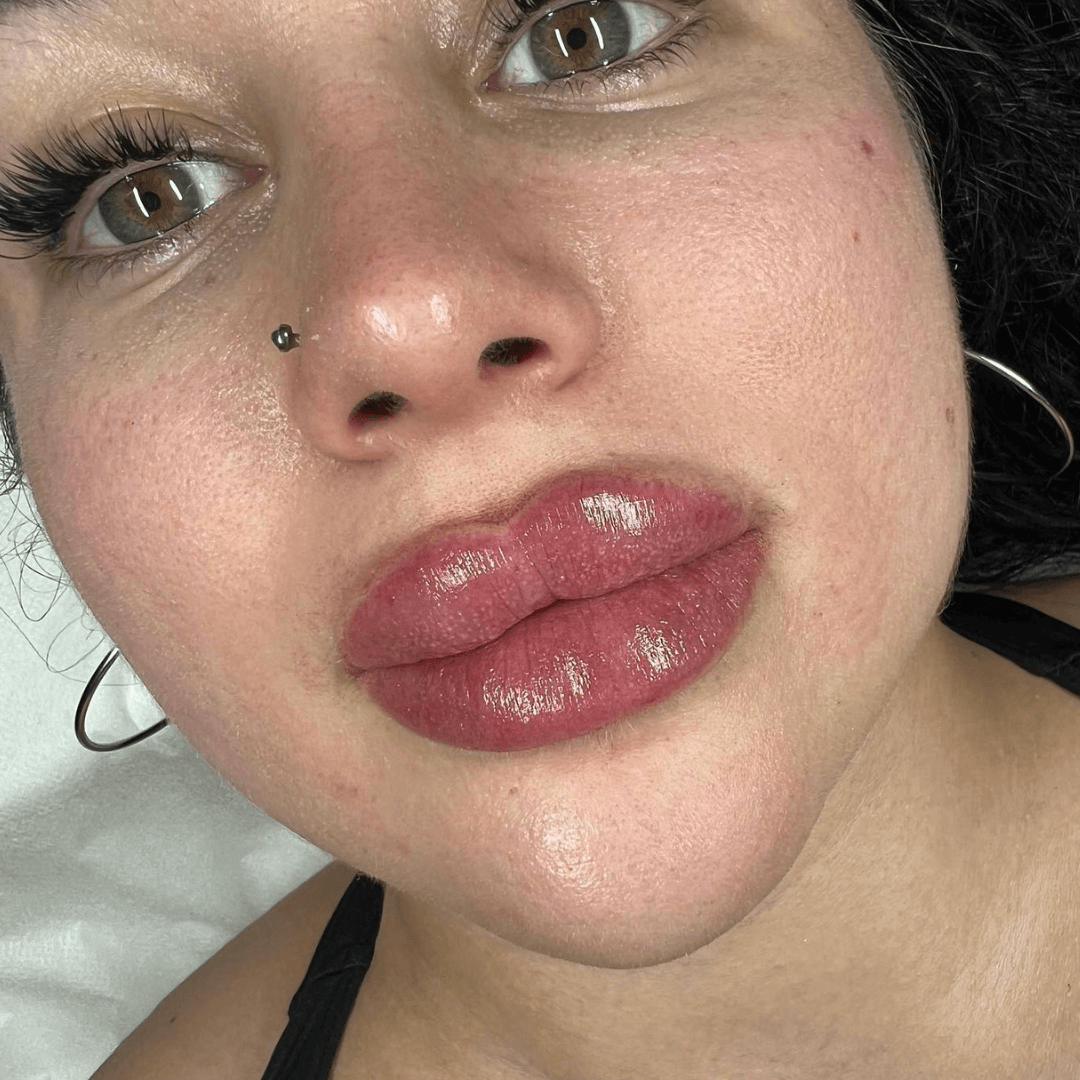 aumento-de-labios-implantes-labiales