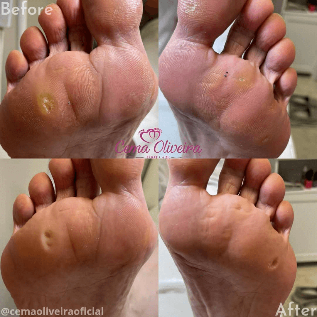 Medical pedicure