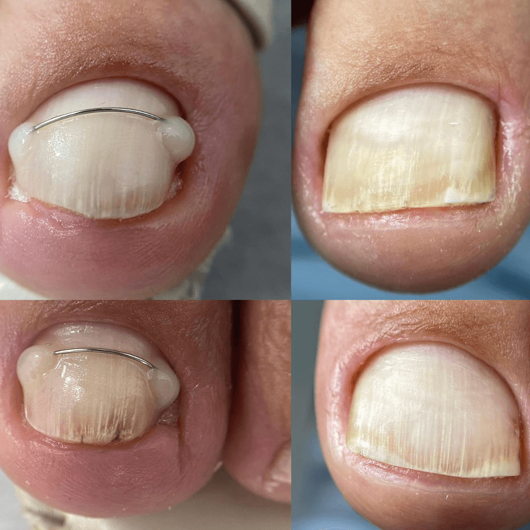 Medical pedicure