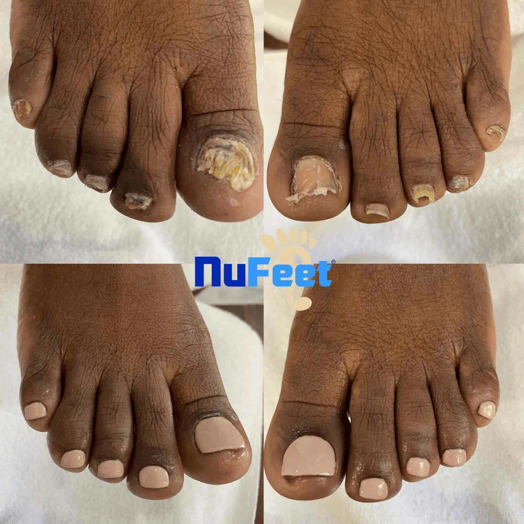 Medical pedicure