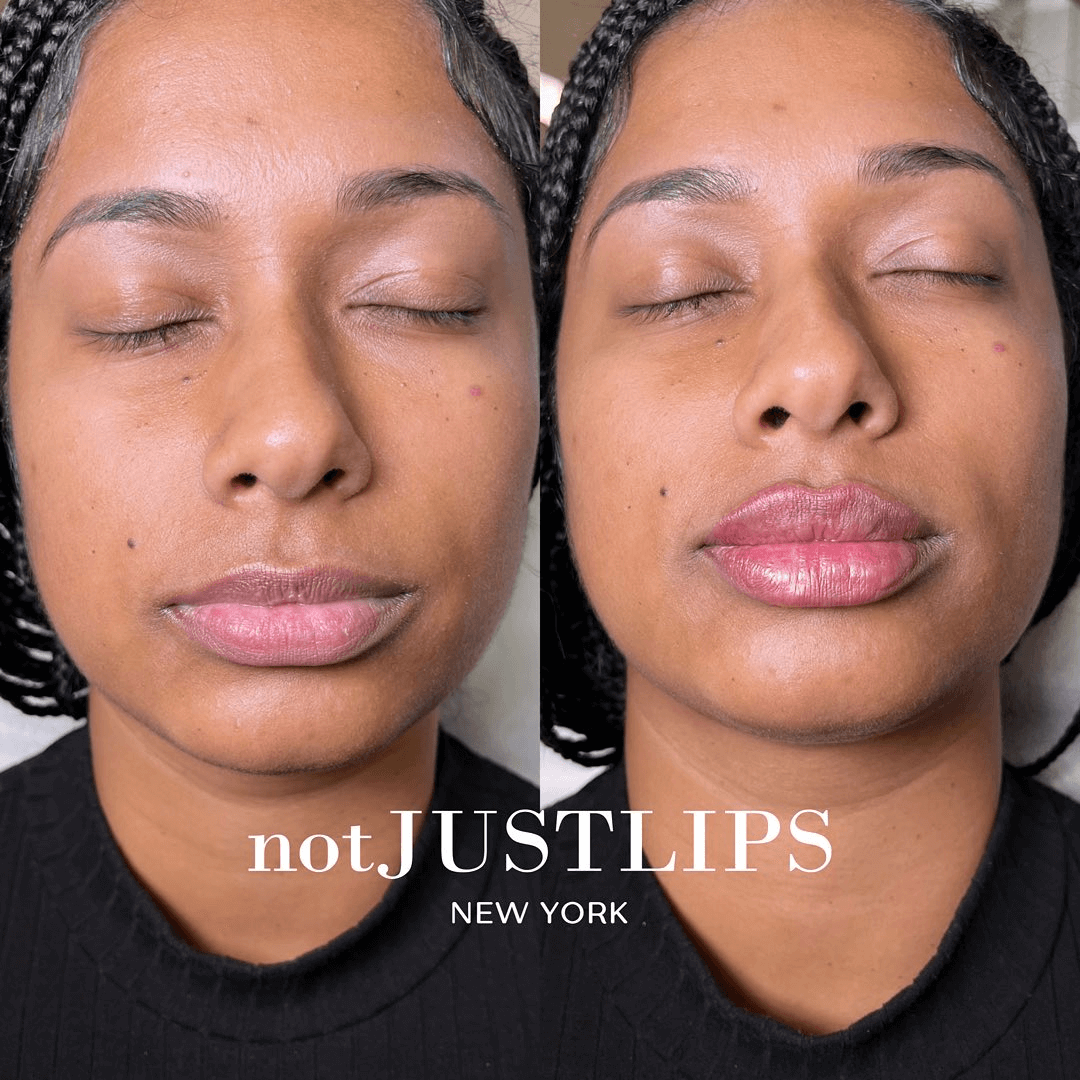 lip-augmentation-fat-grafting