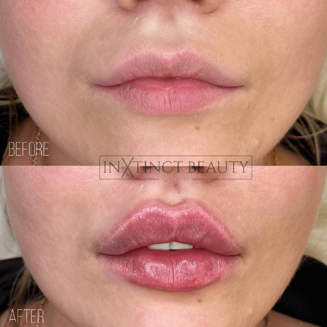 lip-augmentation-cupids-bow-enhancement