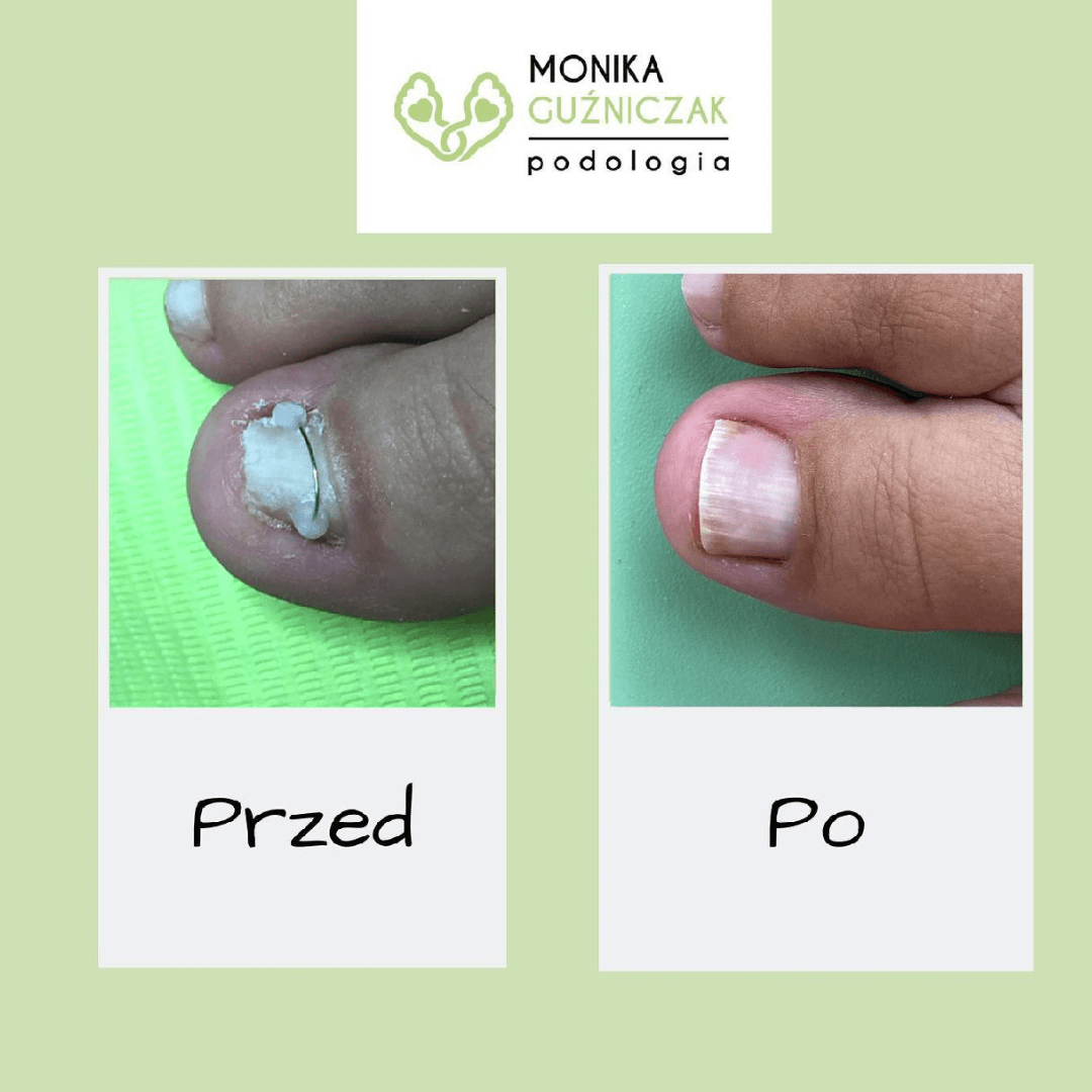 Pedicure podologiczny