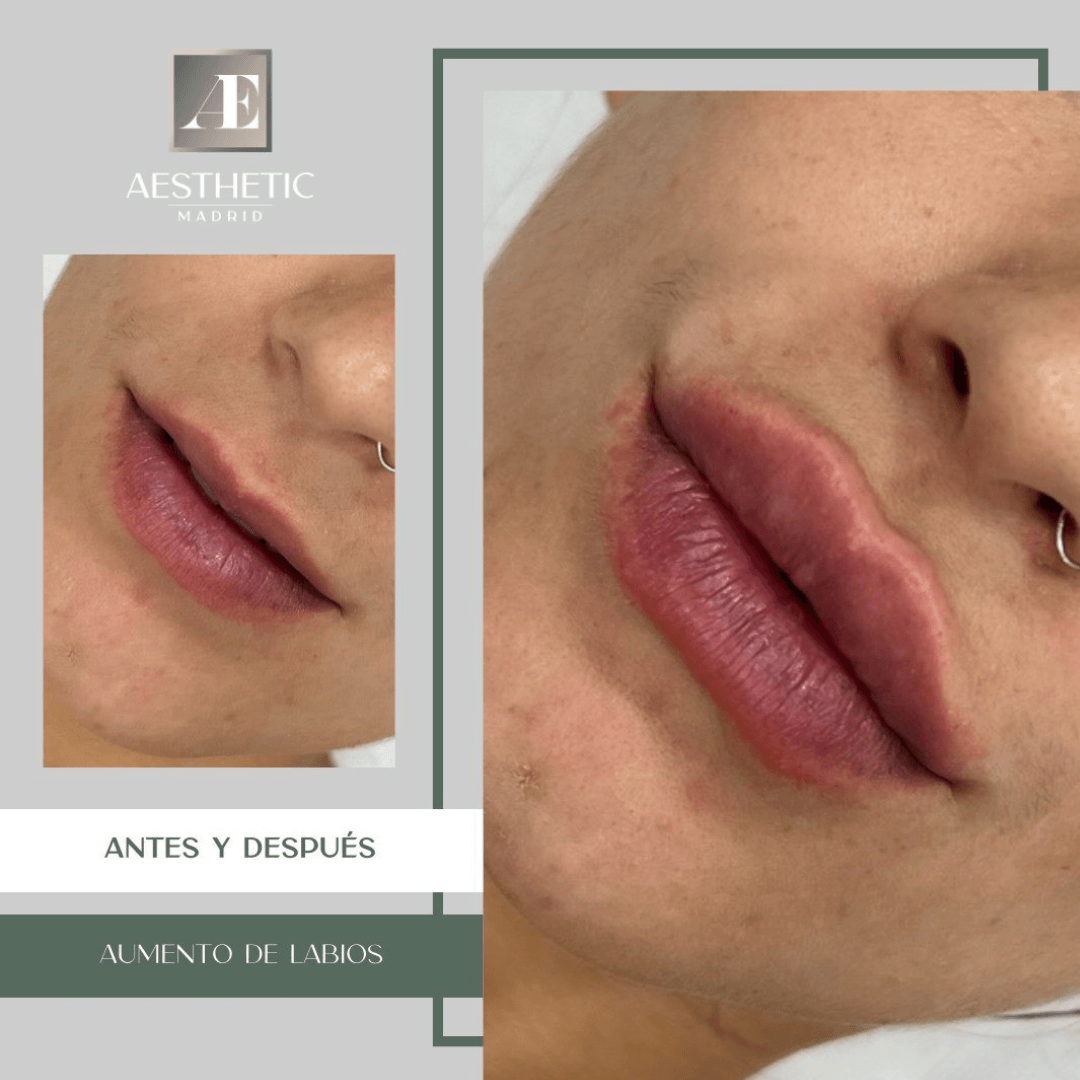 aumento-de-labios-lip-lift