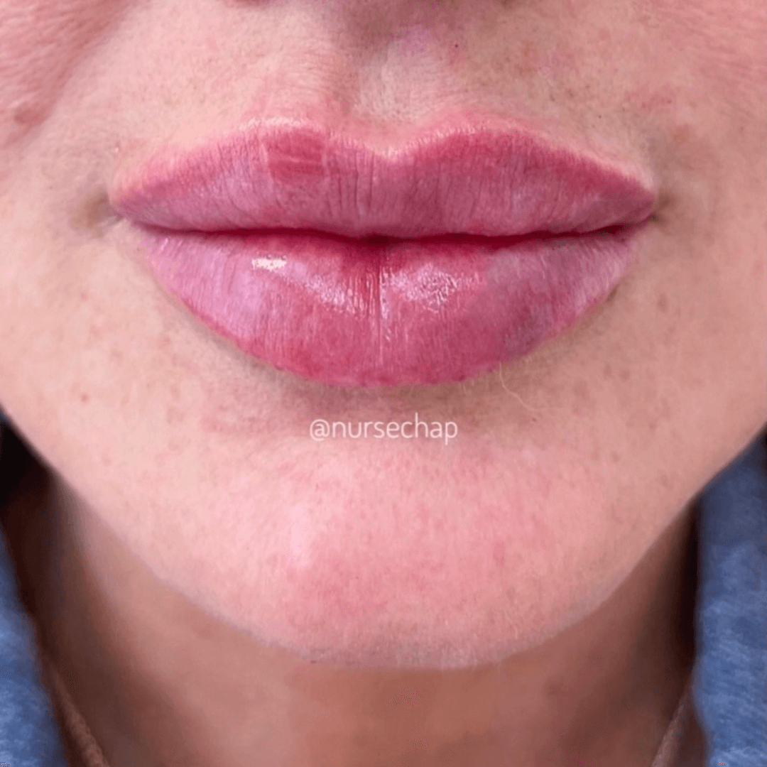lip-augmentation-heart-shaped-lips