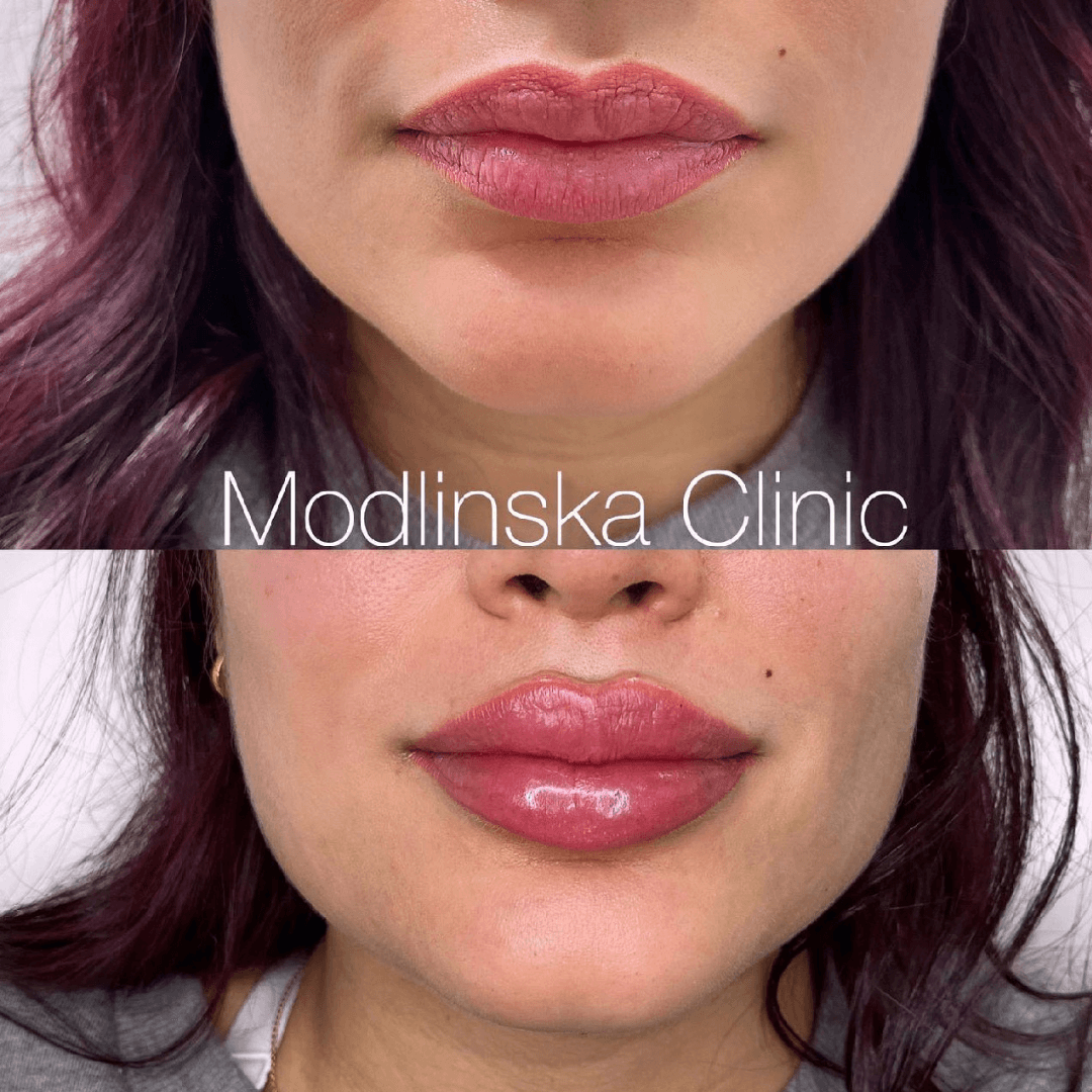 lip-augmentation-russian-style-lips